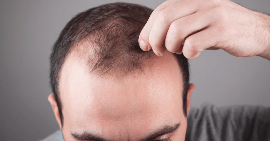 Кому лучше всего подходит PP405 для лечения алопеции: пол, возраст, генетика - Фото 19